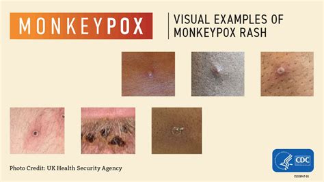 Visual Examples | Mpox | Poxvirus | CDC