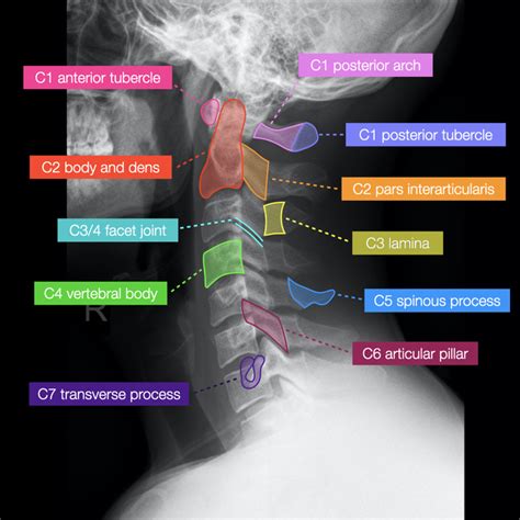 Cervical Spine Xray