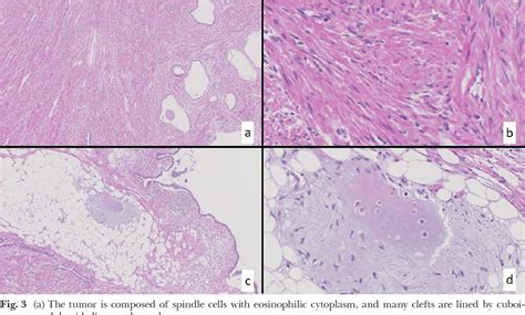 Giant Pulmonary Hamartoma with Dominant CD34- Positive Smooth Muscle Cell Component. | Semantic ...