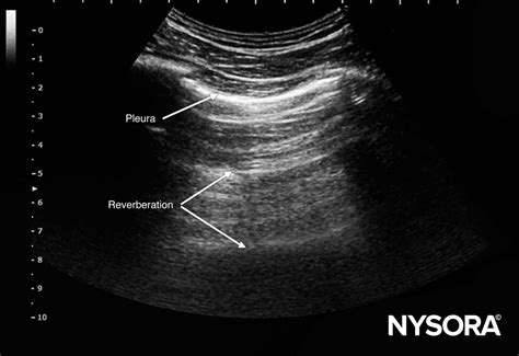 Ultrasound image artifacts explained - NYSORA | NYSORA