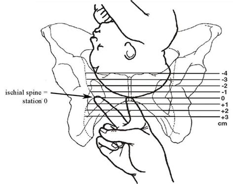 Fetal station | Ostetricia, Studenti di infermeria, Gravidanza