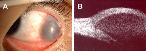 A conjunctival cyst with delayed internal hemorrhage after strabismus surgery - Journal of the ...