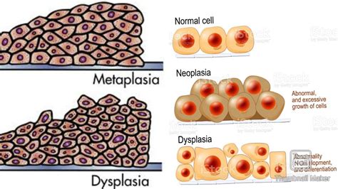 Metaplasia and dysplasia 😀 - YouTube