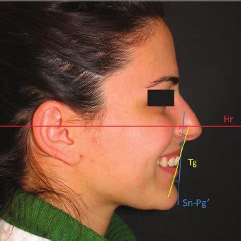 Angular measurements of incisor inclination on a smiling profile... | Download Scientific Diagram