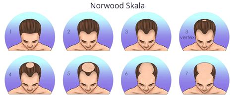 Wie Viele Grafts Brauche Ich? | Norwood Skala - Heva Clinic Türkei