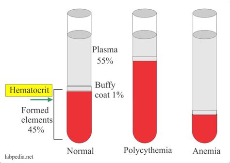 Hemoglobin:- Part 4 – Hematocrit (HCT, Hct), Packed Cell Volume (PCV ...