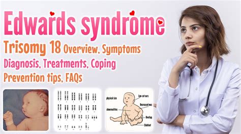 Edwards syndrome trisomy 18 causes, symptoms, diagnosis, treatment ...