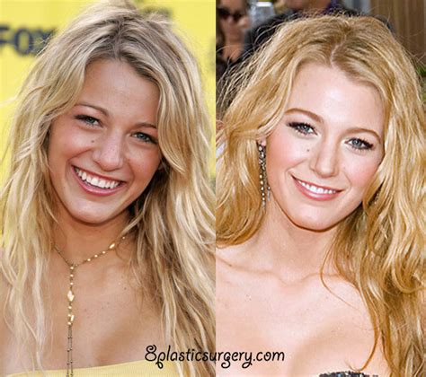 Blake Lively ~ 100 plastic surgery