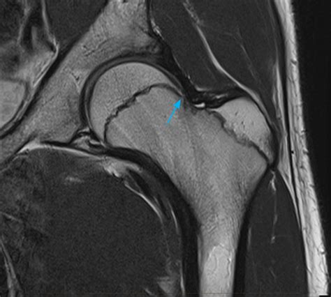 6-fai-mri-hip-melbourne-radiology - MRI at Melbourne Radiology Clinic