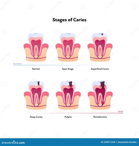 Tooth Anatomy and Decay Chart. Vector Biomedical Illustration. Cross ...