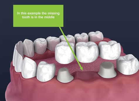 Dental Bridges – Chapel House Dentistry