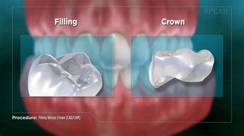 Filling-vs-Crown - Birmingham Smiles Dentistry