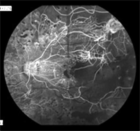 Fluorescein Angiography- Retina Ophthalmology in Frederick MD - Greater Potomac Retina