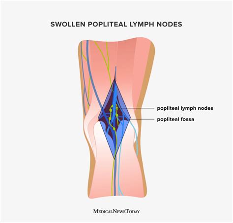 Swollen Lymph Nodes Diagram