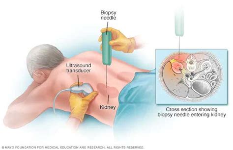 Biopsy and Drainage Procedure in Jaipur | Flowcare