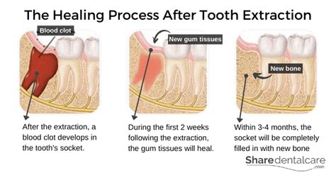 civilização Subtropical corredor bone healing after tooth extraction ...