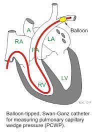 PULMONARY WEDGE PRESSURE (USMLE Step, 55% OFF