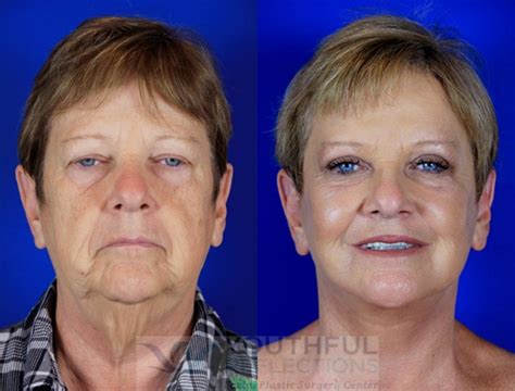 CO2 Laser Skin Resurfacing Before & After Photos Patient 2 | Nashville, TN | Youthful Reflections