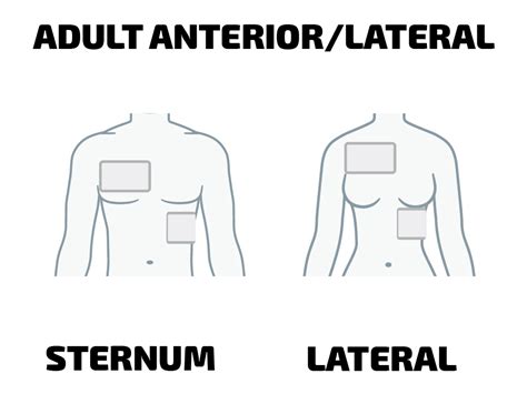 AED Pad Placement | Heartsmart