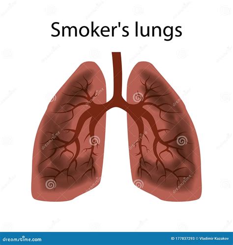 Smoker`s Lungs. Damage To The Lungs Of A Person Caused By Smoking. Cartoon Vector ...