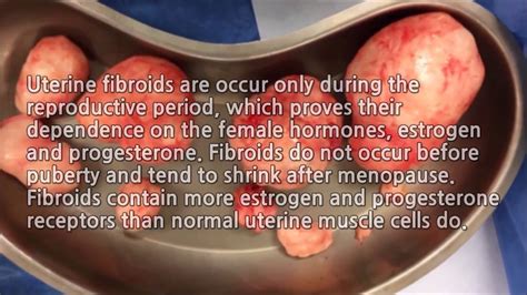 Uterine Fibroids: Innovative 100% natural treatment without surgery ...