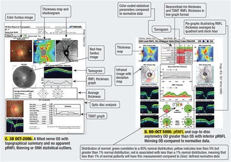 The Anatomy of an OCT Scan