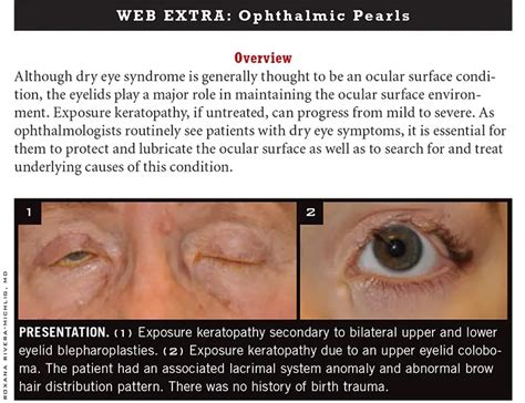 Management of Exposure Keratopathy - American Academy of Ophthalmology