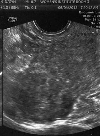 Uterine Fibroids | Radiology Key