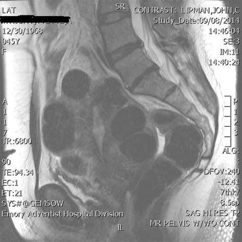 Imaging with MRI - Why You Need an MRI to Detect Fibroids