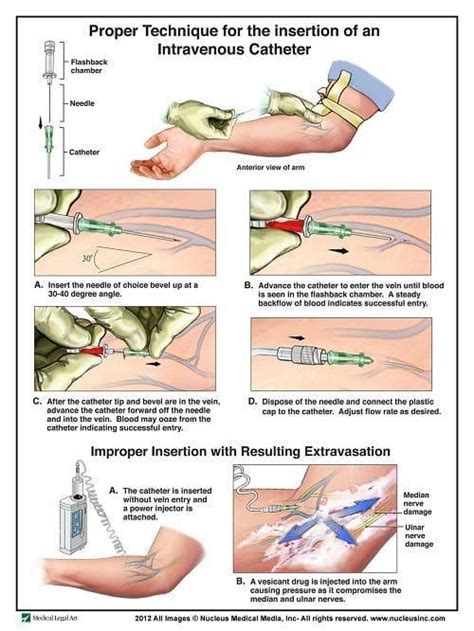 50+ IV Therapy Tips and Tricks: The Ultimate Guide | Iv insertion ...