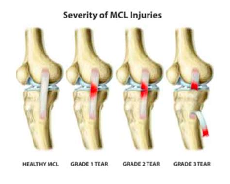 Grade 2 Ligament Sprain - Sprained Ankle Orthoinfo Aaos / The ligament ...