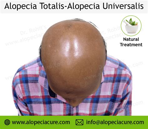 Alopecia Universalis