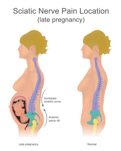 Pregnancy Back Pain Treatment: Causes & Therapy | QI Spine