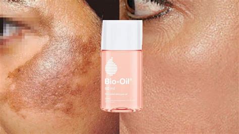 Bio Oil Before And After Pictures Scars - PictureMeta