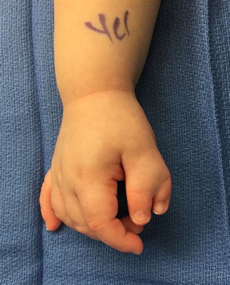 Congenital Hand and Arm Differences: June 2020