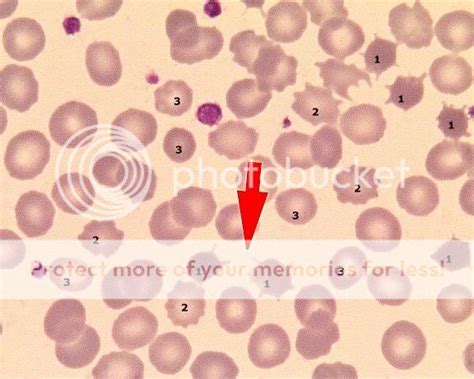 acanthocytes.jpg Photo by usmle | Photobucket