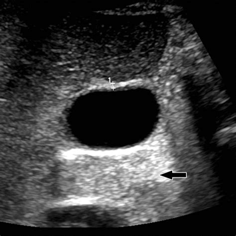 Clinical Significance of US Artifacts | RadioGraphics