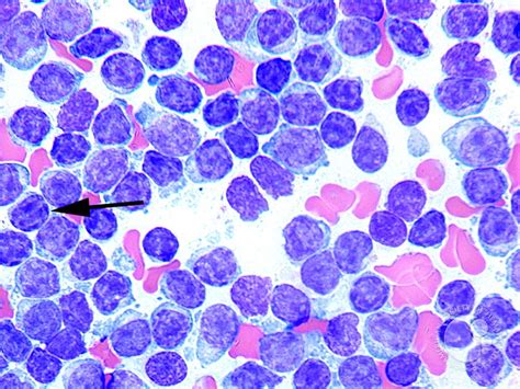 Chronic Lymphocytic Leukemia - 3.