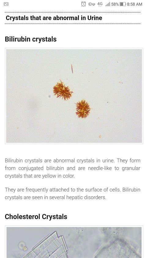 Bilirubin crystals | Medical laboratory scientist, Crystals, Medical ...