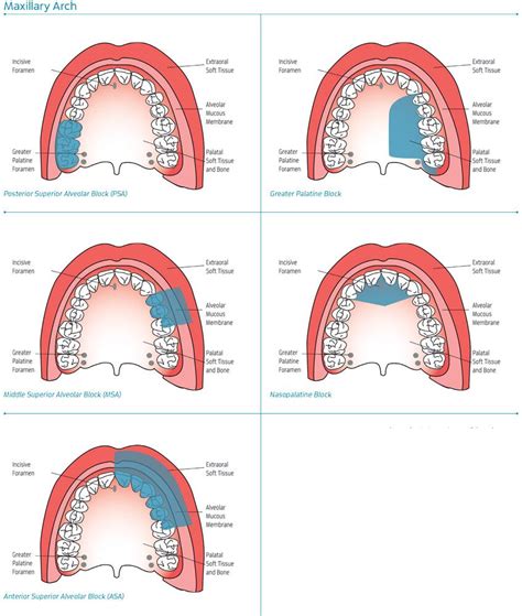 Maxillary Injection Sites | Dental hygiene school, Dental hygiene student, Dental anatomy