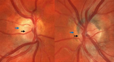 Incidental bilateral optic nerve hypoplasia | BMJ Case Reports