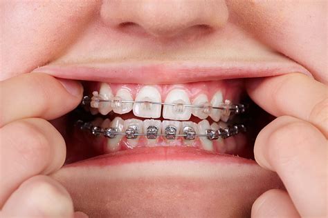 Teeth with orthodontic brackets. - M. Scott Runnels D.M.D., P.A.