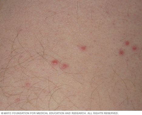 Bedbugs - Symptoms and causes - Mayo Clinic