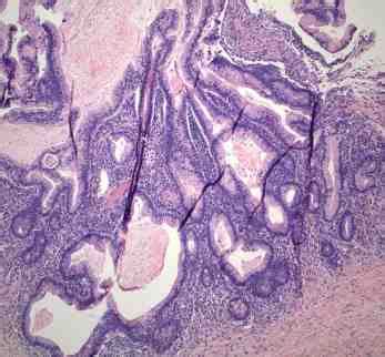 Pathological examination of case 1 shows a stage IA mucinous borderline ...