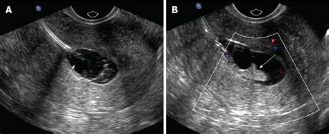 [Get 30+] Uterine Cancer Ultrasound