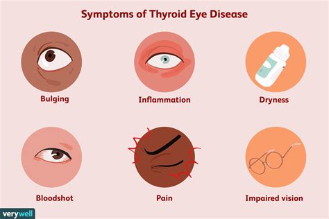 Pin by Brookejenn on {Eye Notes} | Thyroid symptoms, Disease symptoms ...