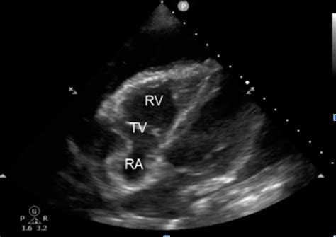 Differentiating pericardial effusion from pericardial tamponade on ...