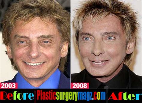 Barry Manilow Plastic Surgery Before and After | Plastic Surgery Magazine