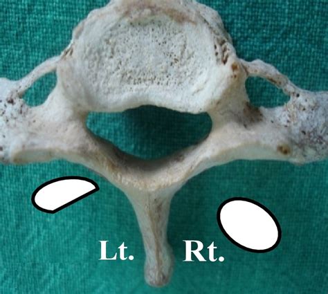 Anatomical Variations of Foramen Transversarium of 7th Cervical Vertebrae and Its Clinical ...