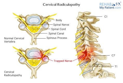 Cervical Radiculopathy (Pinched Nerve) | Rehab My Patient